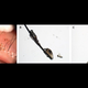 Images of the patient’s lice captured via slit-lamp examination (A) and via a microscope (B and C)